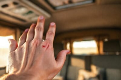 Una mano con quemadura menor